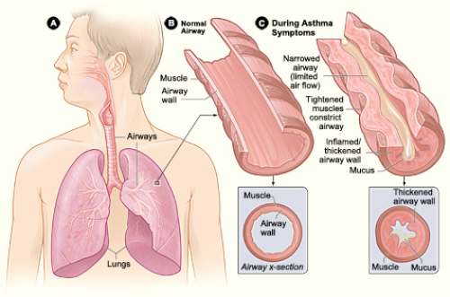 asthma